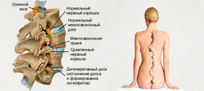 Остеохондроз и его лечение
